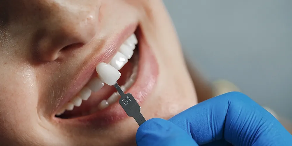 emaxreplacementwomanteeth Marmara Smile